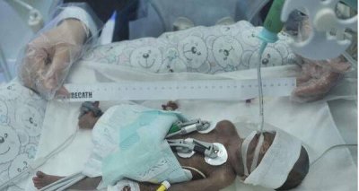 ​中国最小的婴儿仅沉250g，李思源660g记录被改写_组图