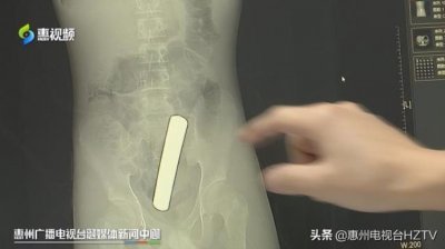 ​这种好奇要不得小伙将12公分铜条塞进体内差点扎破肠子