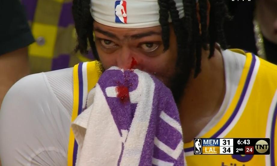 浓眉被打出血(究竟是打球还是打人)