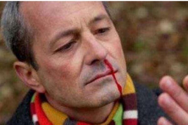 经常流鼻血是怎么回事 经常流鼻血怎么办