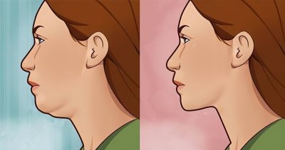 ​你的双下巴可能真不是胖出来的！