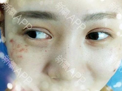 e光祛斑效果怎样?e光祛斑让我的斑更严重-第1张图片-